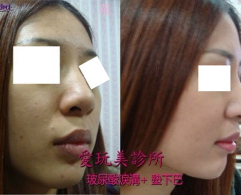 玻尿酸淚溝+墊下巴