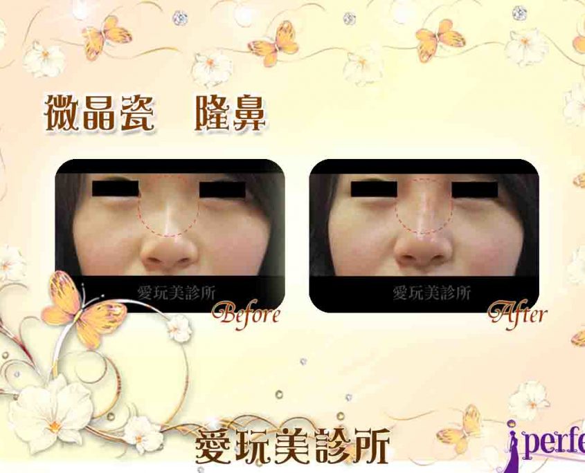 微晶瓷鼻子