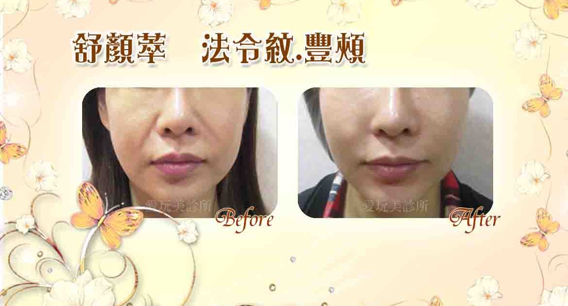 舒顏萃法令紋