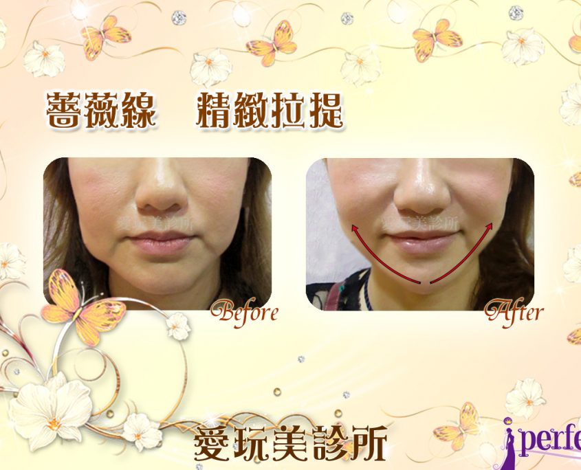 薔薇線拉提