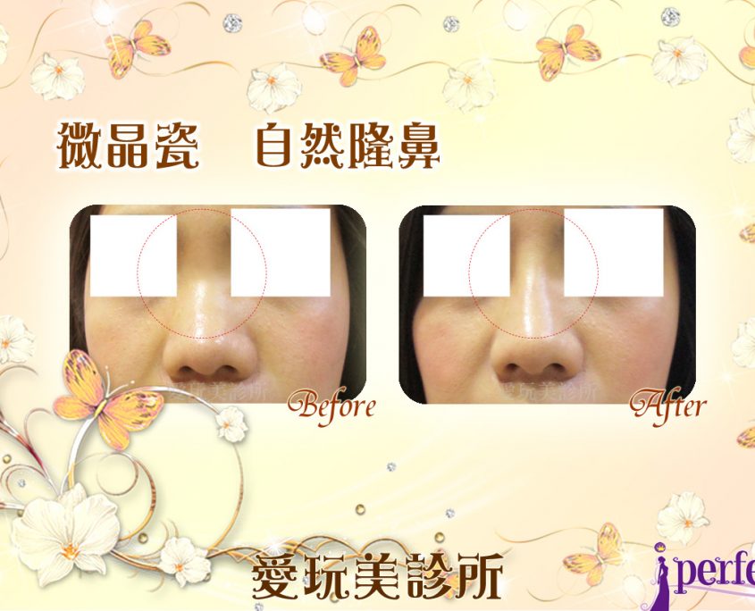 微晶瓷鼻子