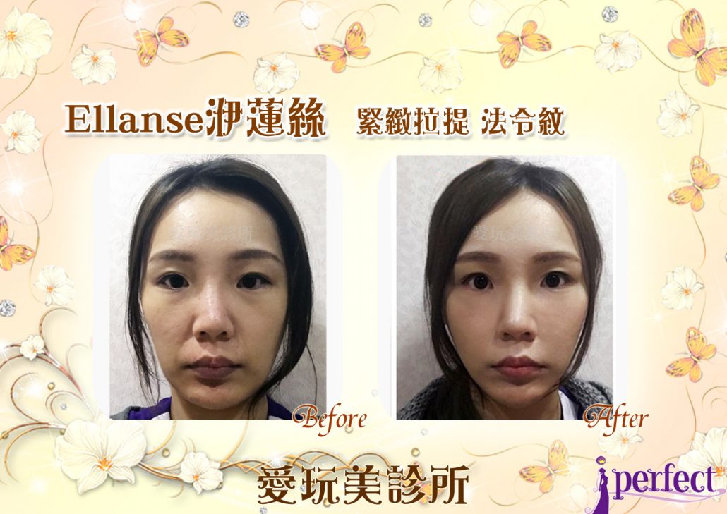洢蓮絲拉提+法令紋