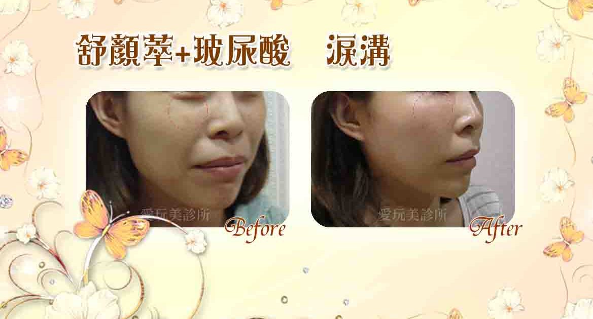 舒顏萃+坡尿酸淚溝、下巴