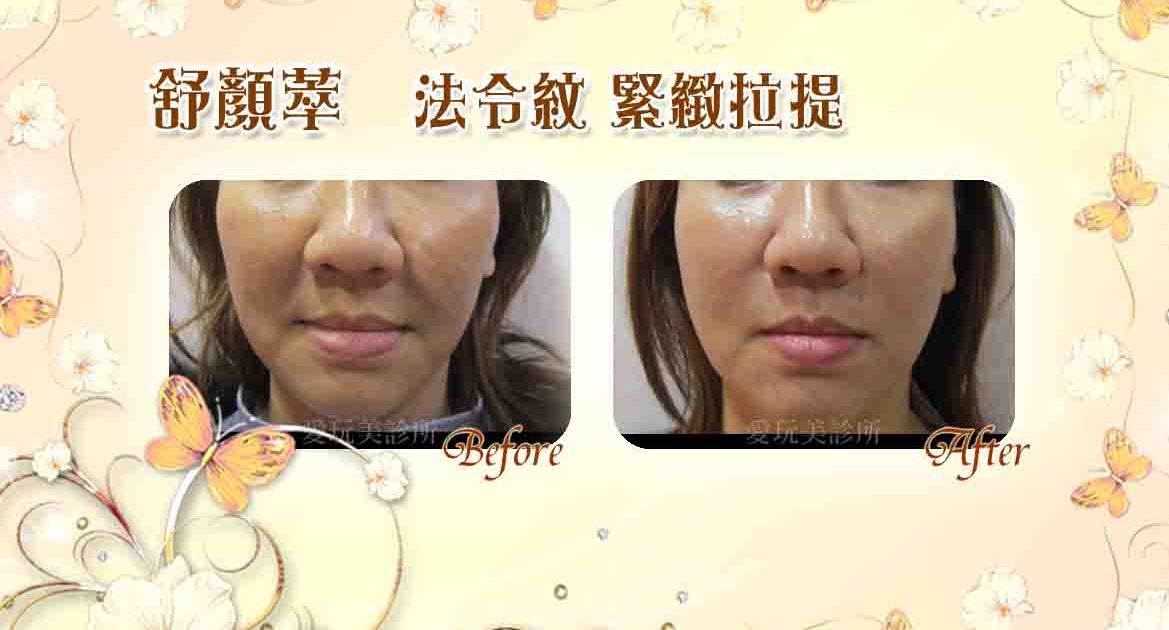 舒顏萃法令紋