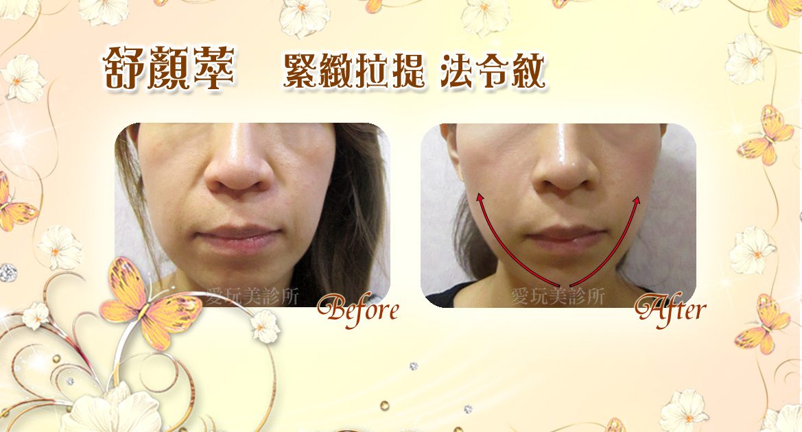 舒顏萃緊緻拉提法令紋