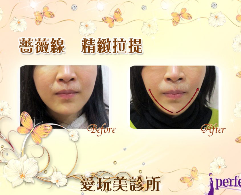 薔薇線拉提