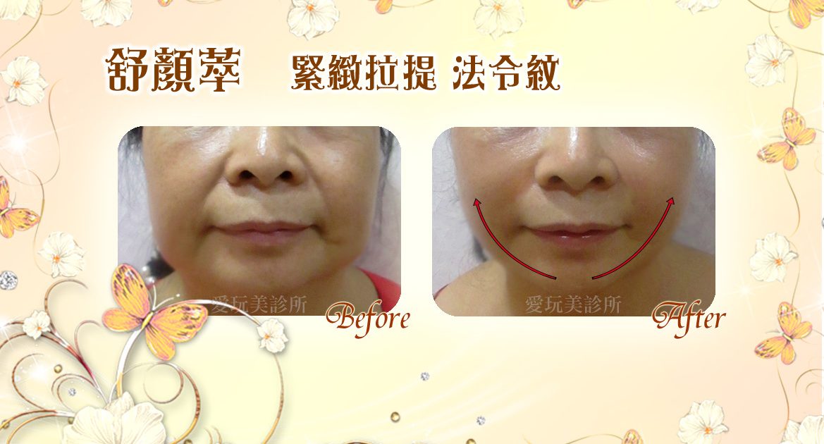 舒顏萃緊緻拉提法令紋