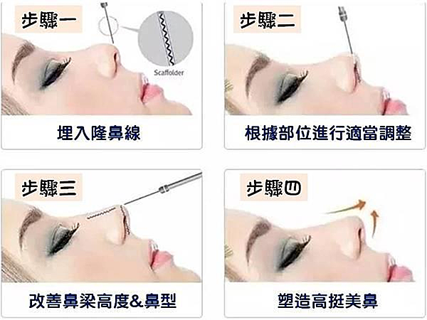 韓式線雕隆鼻 ( 埋線隆鼻 )的施作步驟,先在鼻部施打局部麻醉,從鼻頭埋入人體可吸收蛋白線雕塑鼻型,在鼻頭注射少許玻尿酸,使整體更為自然。 韓式線雕隆鼻 ( 埋線隆鼻 )的施作步驟,先在鼻部施打局部麻醉,從鼻頭埋入人體可吸收蛋白線雕塑鼻型,在鼻頭注射少許玻尿酸,使整體更為自然。