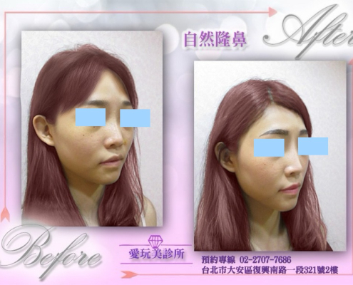 玻尿酸隆鼻