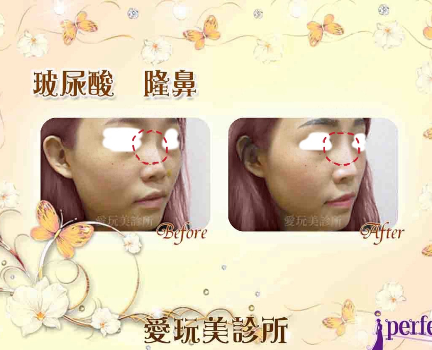 玻尿酸隆鼻
