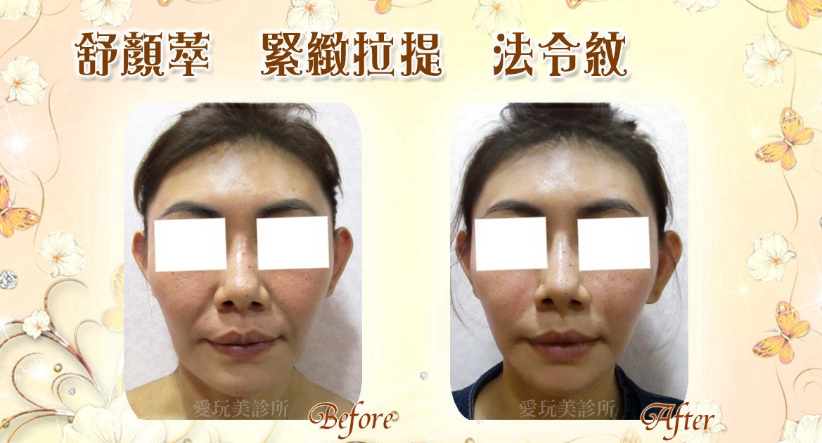 舒顏萃童顏針緊緻拉提法令紋