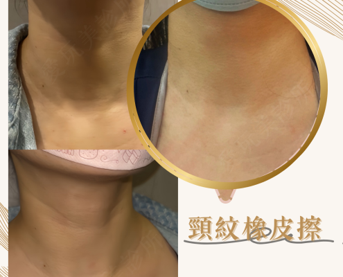 PROFHILO 逆時針 脖子