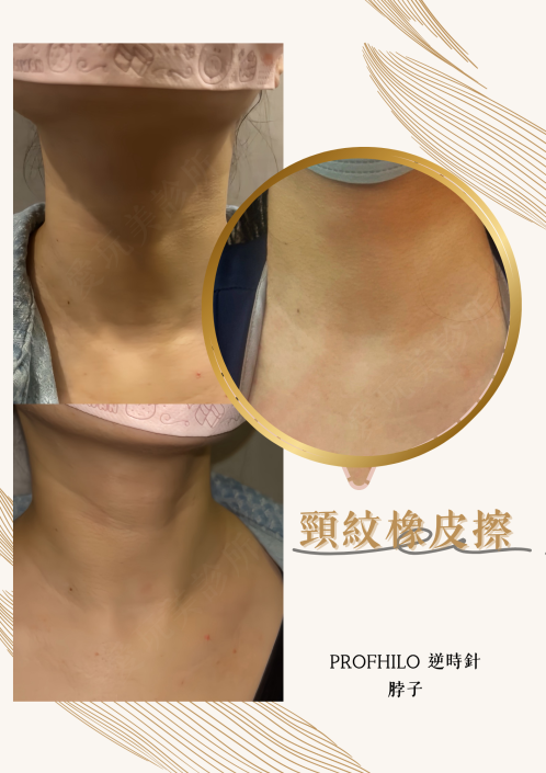 PROFHILO 逆時針脖子 PROFHILO 逆時針脖子